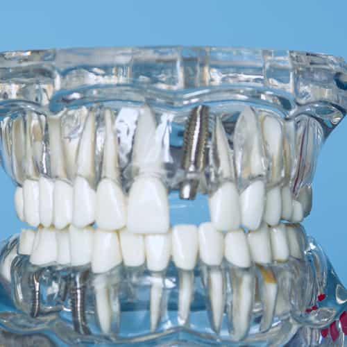 Dental Crowns in Los Algodones, Mexico: Top Affordable Clinics for Californians